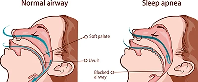 sleep apnea diagram