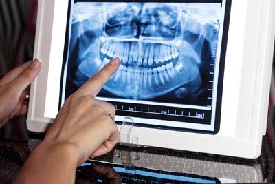 intraoral imaging technology used at Acre Wood Dental - Temple
