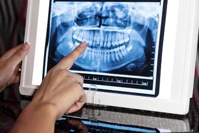 intraoral imaging technology used at Acre Wood Dental - Temple