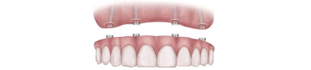 All-on-4-dental implant